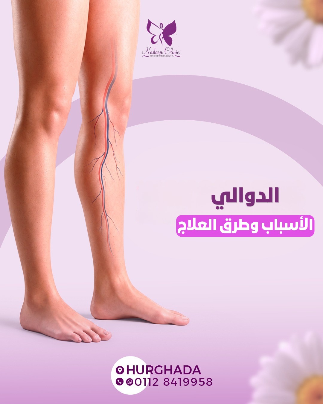 الدوالي الأسباب وطرق العلاج في الغردقة